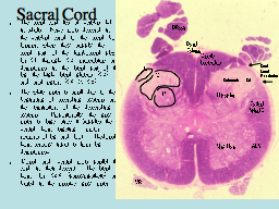 Sacral Cord