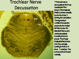 Trochlear Nerve  Decussation