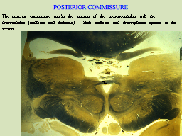 POSTERIOR COMMISSURE